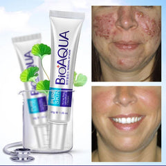 BioAqua Acne Cream Anti-Wrinkle Removal Scar Blemish Marks Removal Unisex - YehChez.pk
