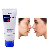 Mistine Acne Clear Facial Foam 85 ml - YehChez.pk