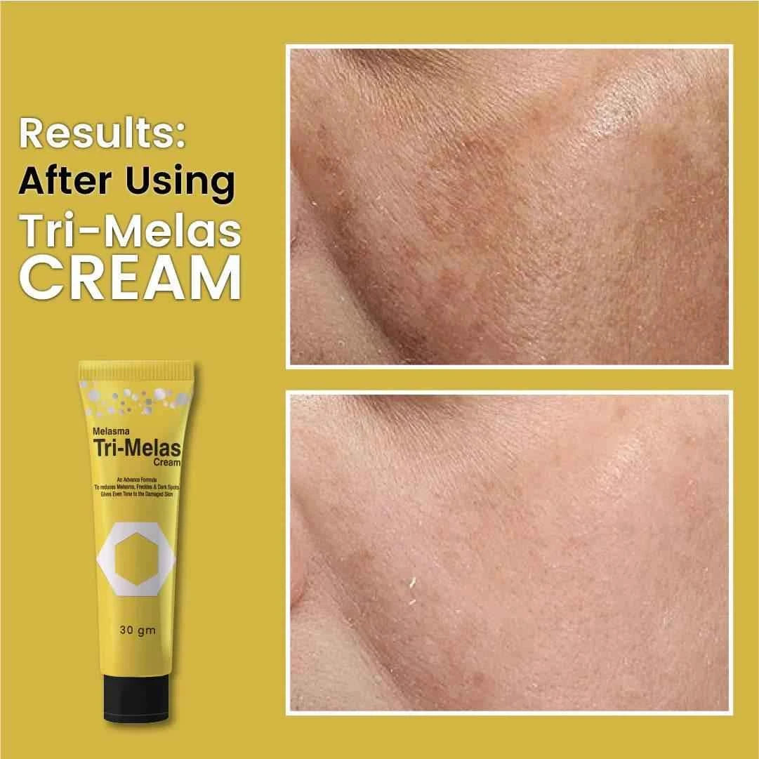 Dr Romia Tri Melas Cream 30 Gram - YehChez.pk