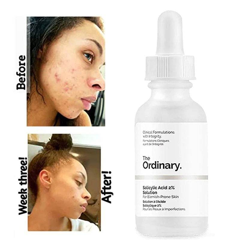 The Ordinary Salicylic Acid 2% Solution 30ml - YehChez.pk